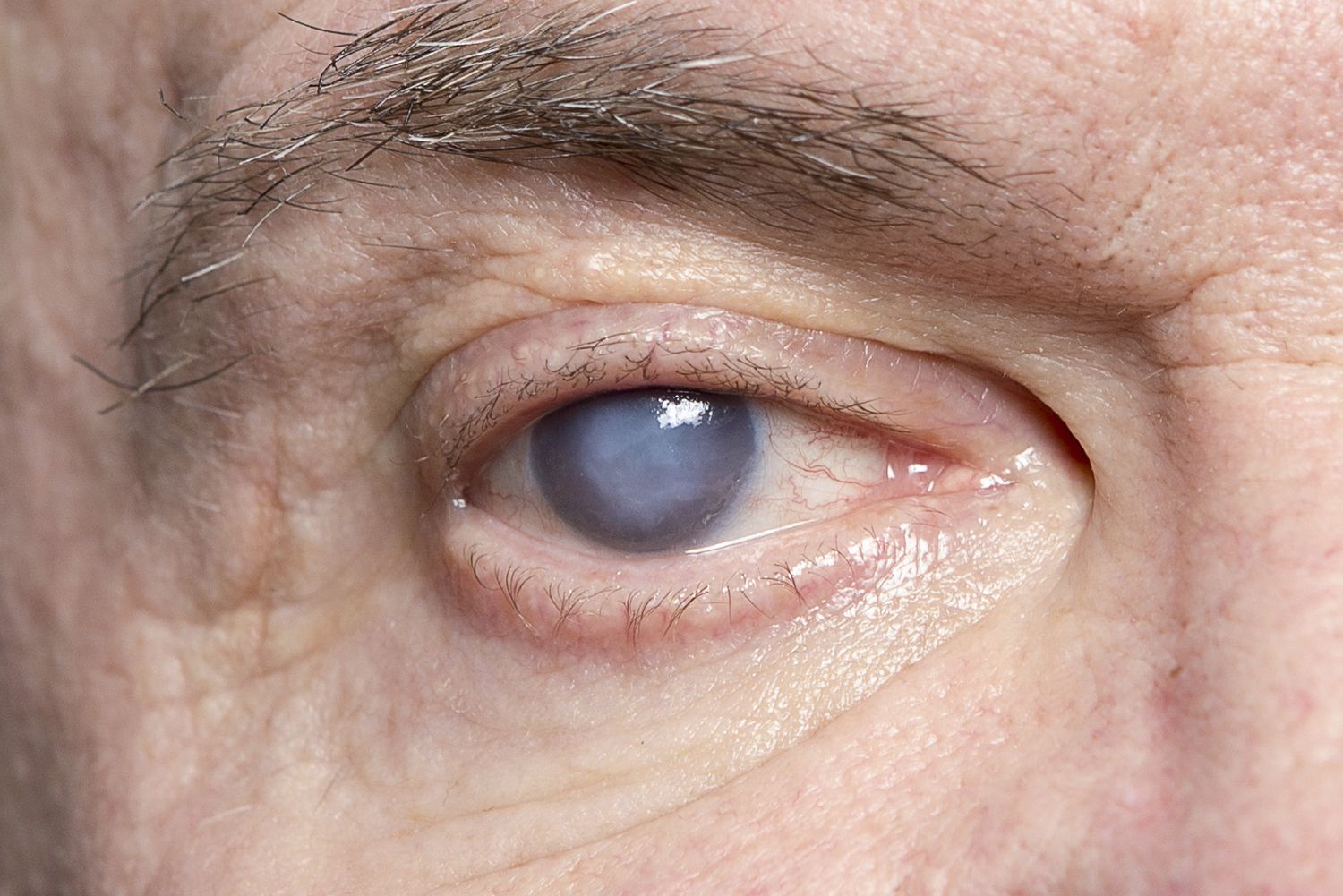 How to recover quickly from cataract eye surgery