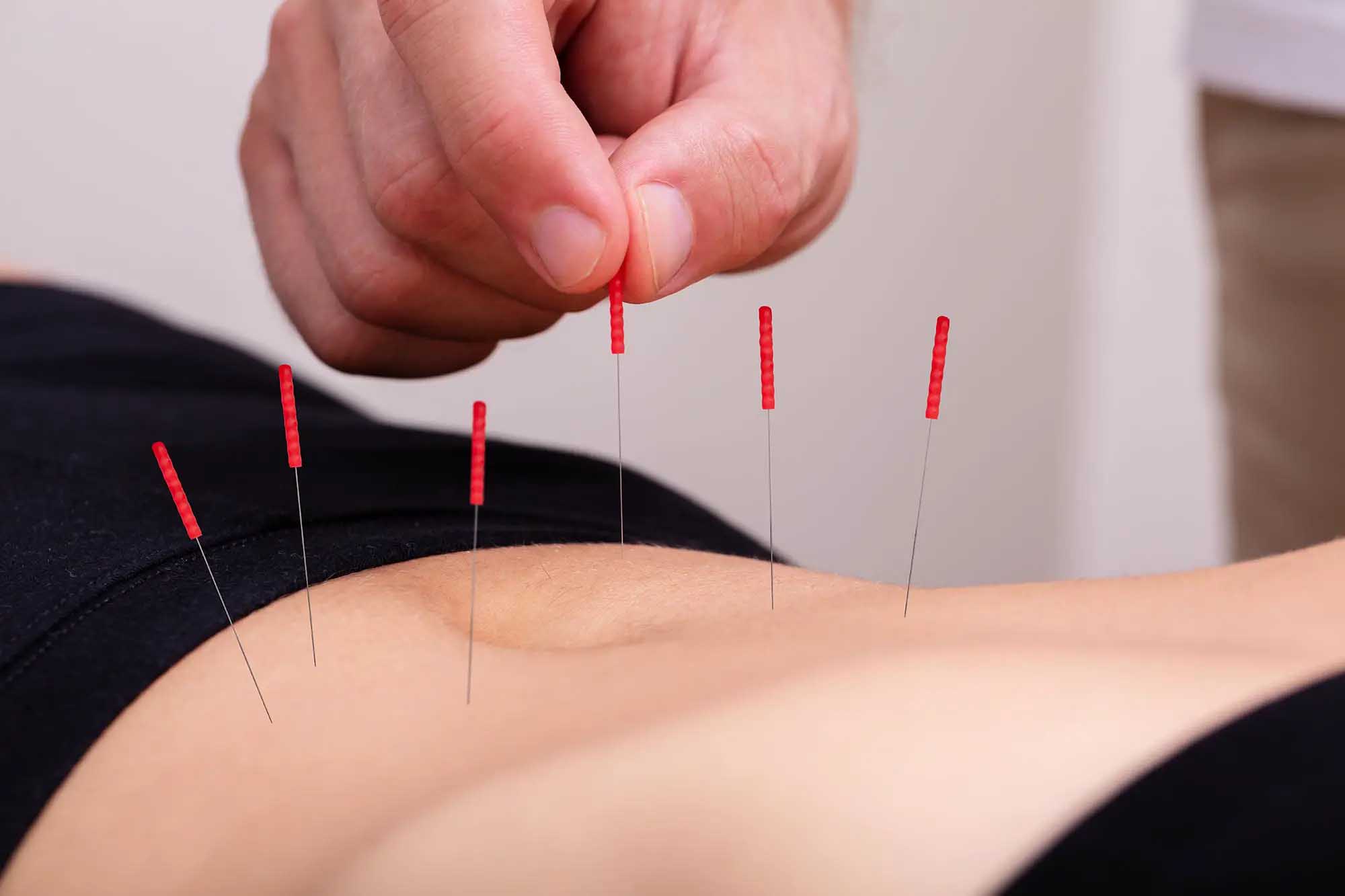 Does Acupuncture Have a Role in Chronic Pain Treatment