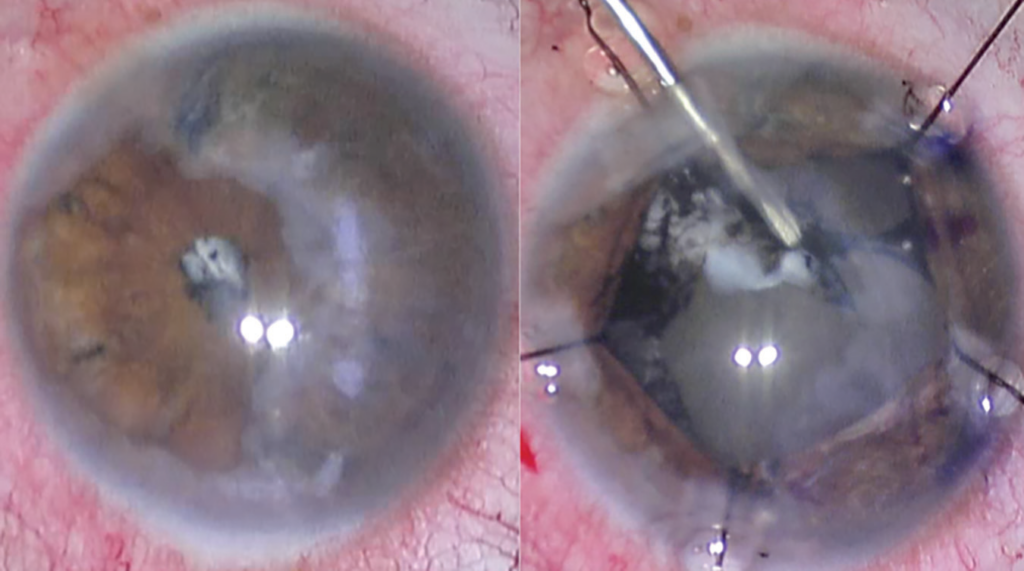 cataract surgery 