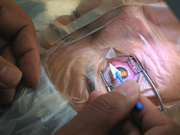 complications of cataract surgery?