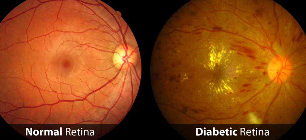 iabetic retinopathy