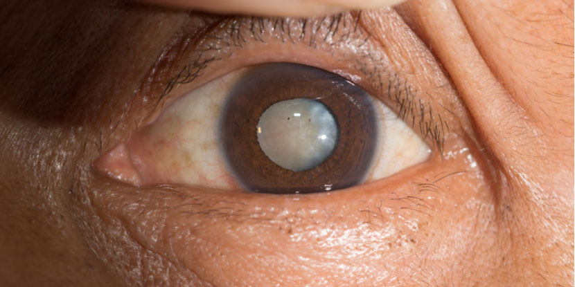 What is a cataract